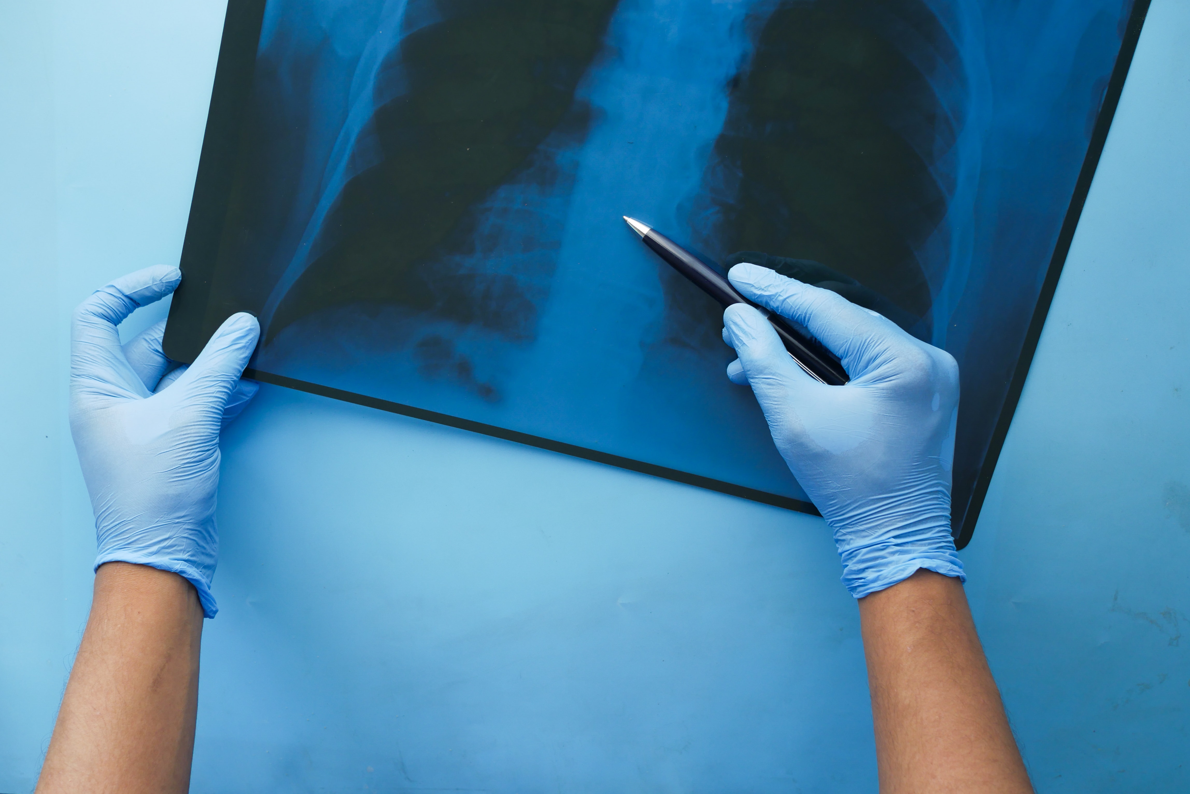 Doctor`s hand holding a x-ray image of a chest